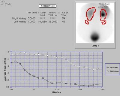 The Diuresis Renogram: How It’s Done and How to Interpret It.